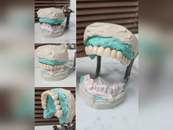 Smile Restored with Bridge and Crown