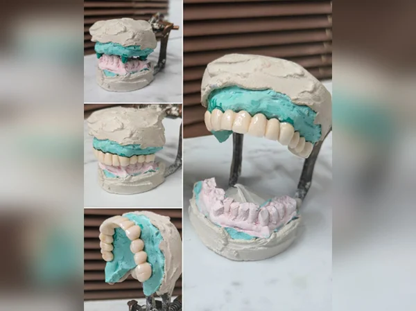 Smile Restored with Bridge and Crown