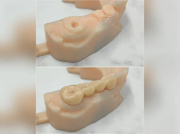 Smile Restored with Bridge and Crown