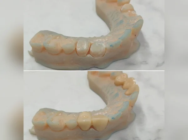Smile Restored with Bridge and Crown