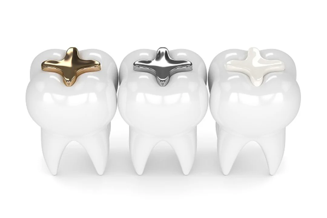 Dental Fillings for Cavities