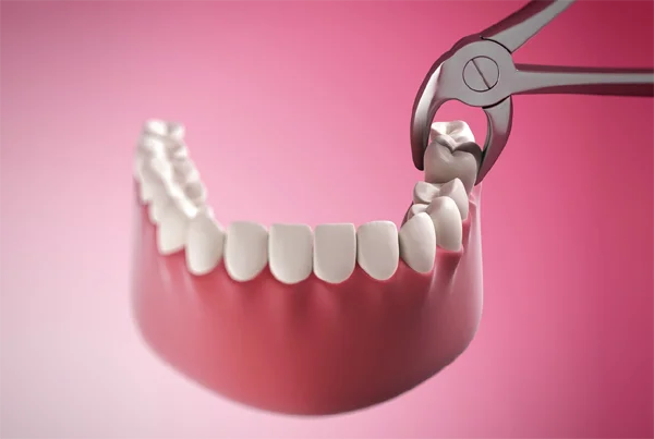 Tooth Extractions, Including Wisdom Tooth Removal