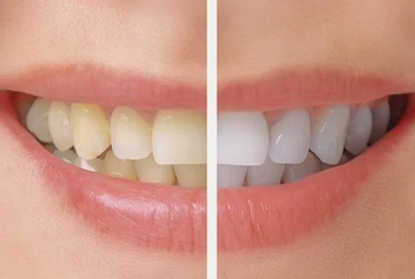 Teeth Whitening Bleaching