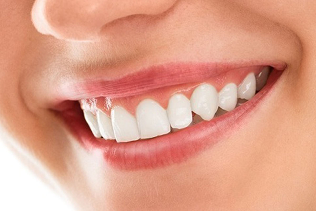 Smile Makeover and Aesthetic Dentistry