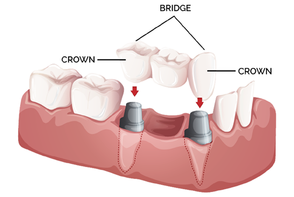 Dental Crowns and Bridges
