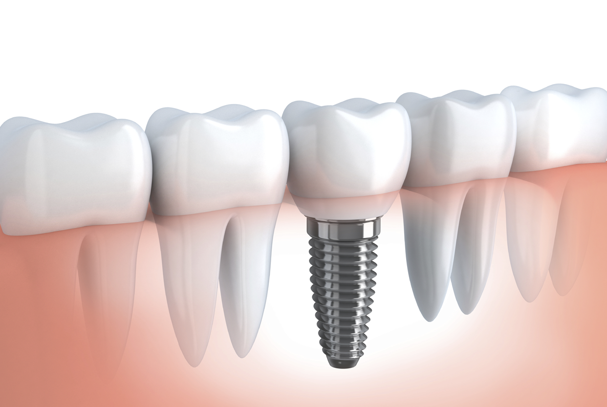Dental Implants for Missing Teeth