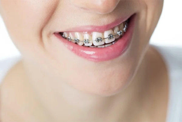 Metal and Ceramic Braces