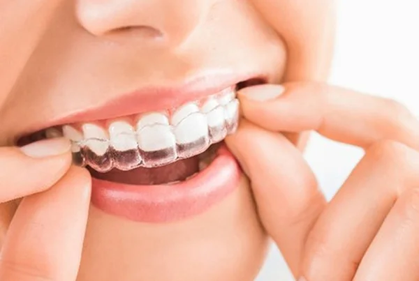 Invisible Braces Invisalign and Clear Aligners