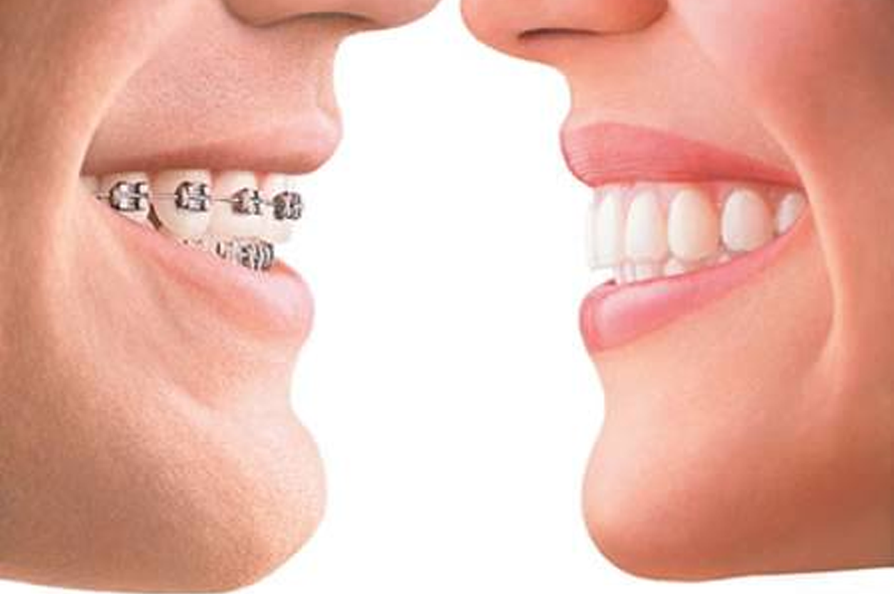 Orthodontics (Braces & Aligners)