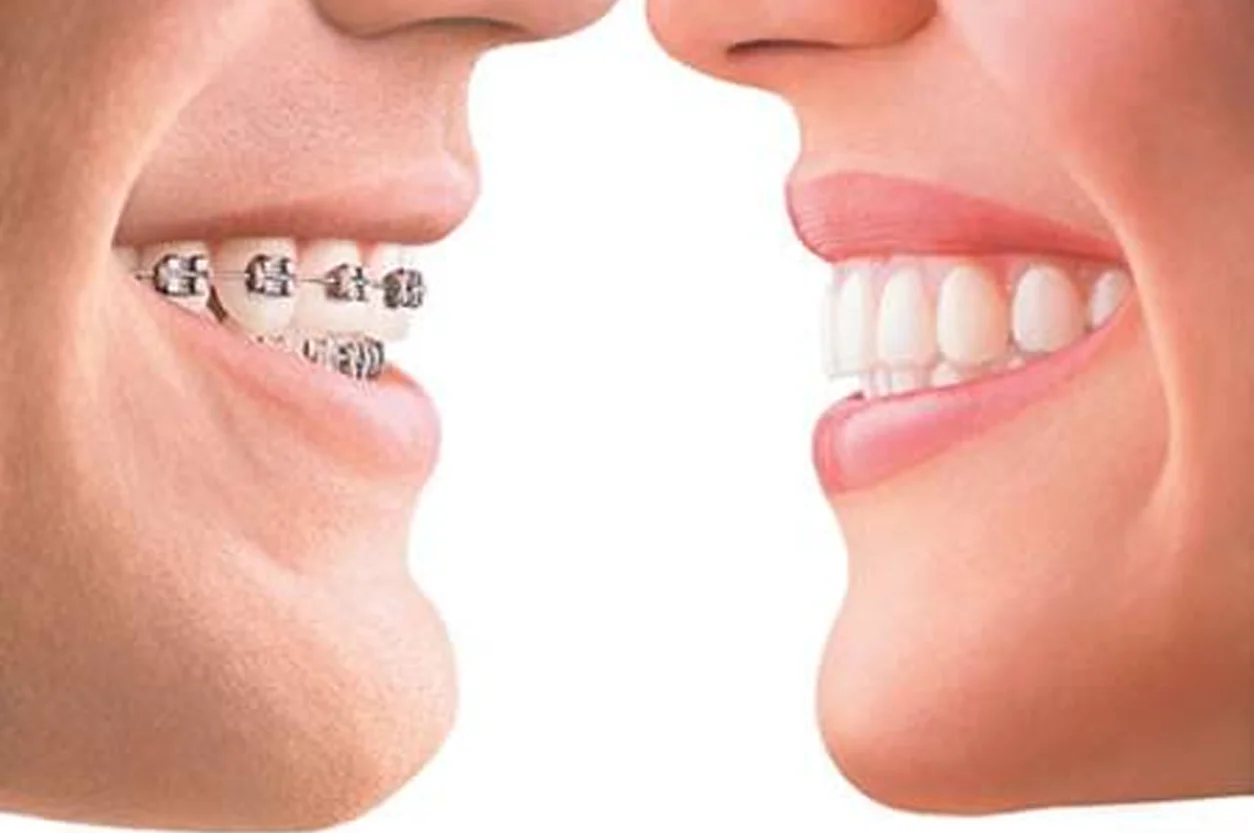 Orthodontics (Braces & Aligners)