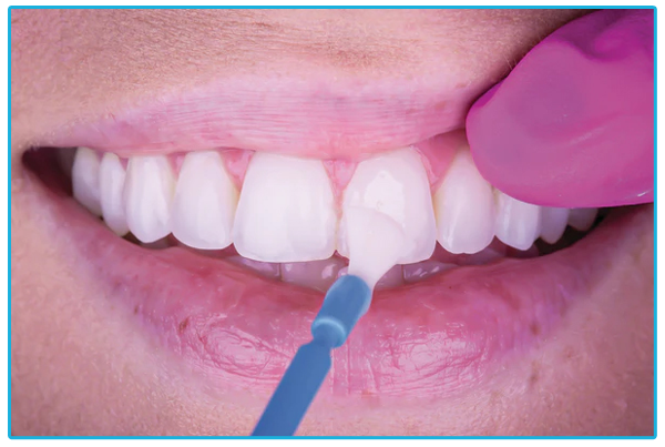 Dental Sealants and Fluoride Treatment