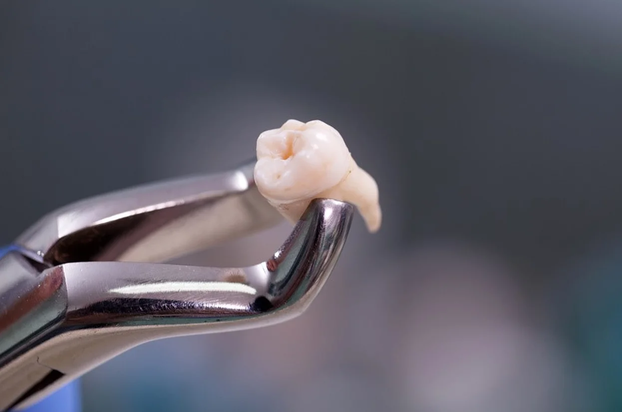 Tooth Extractions Including Wisdom Teeth Removal