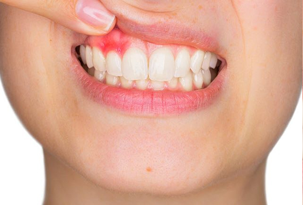 Treatment for Bleeding Gums