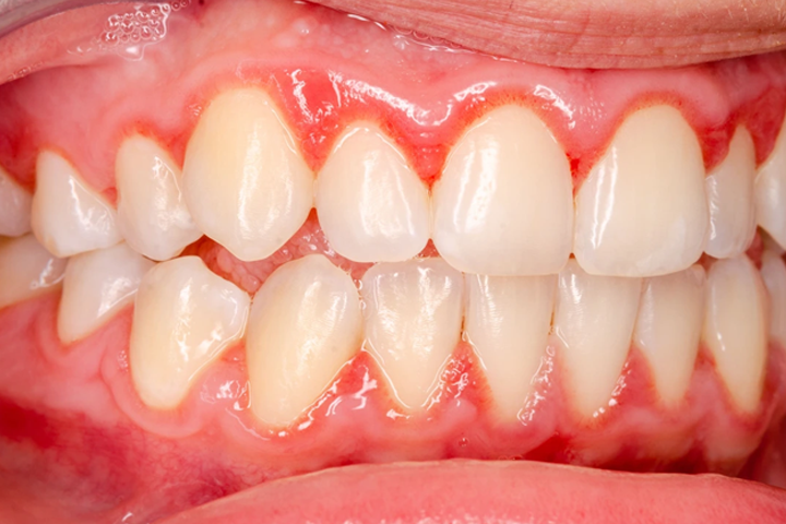 Laser Gum Therapy