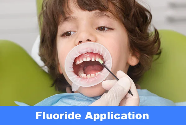 Fluoride Treatments