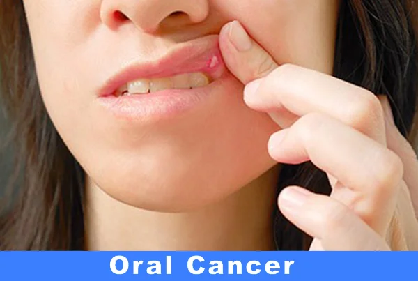 Oral Cancer Screening